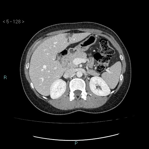 File:Adult transient intestinal intussusception (Radiopaedia 34853-36310 Axial C+ portal venous phase 11).jpg