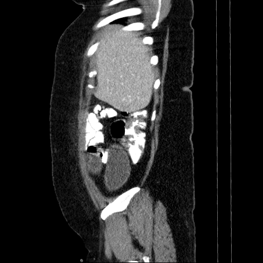 File:Afferent loop syndrome - secondary to incarcerated trocar site hernia (Radiopaedia 82959-97305 Sagittal C+ portal venous phase 134).jpg