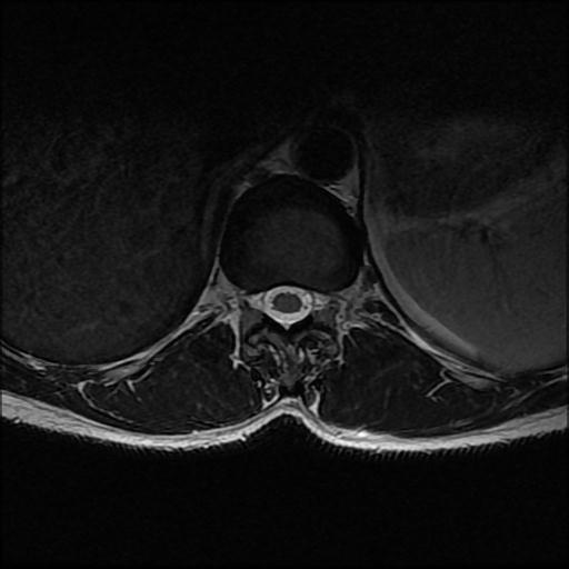 File:Aggressive vertebral hemangioma with pathological fracture (Radiopaedia 69528-79411 Axial T2 18).jpg