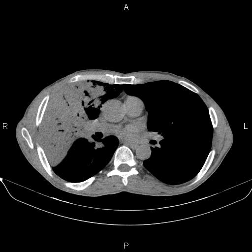 Air bronchogram in pneumonia (Radiopaedia 85719-101512 Axial non-contrast 34).jpg