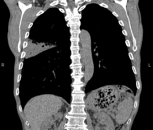 Air bronchogram in pneumonia (Radiopaedia 85719-101512 Coronal non-contrast 39).jpg