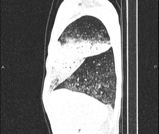 File:Air bronchogram in pneumonia (Radiopaedia 85719-101512 Sagittal lung window 21).jpg