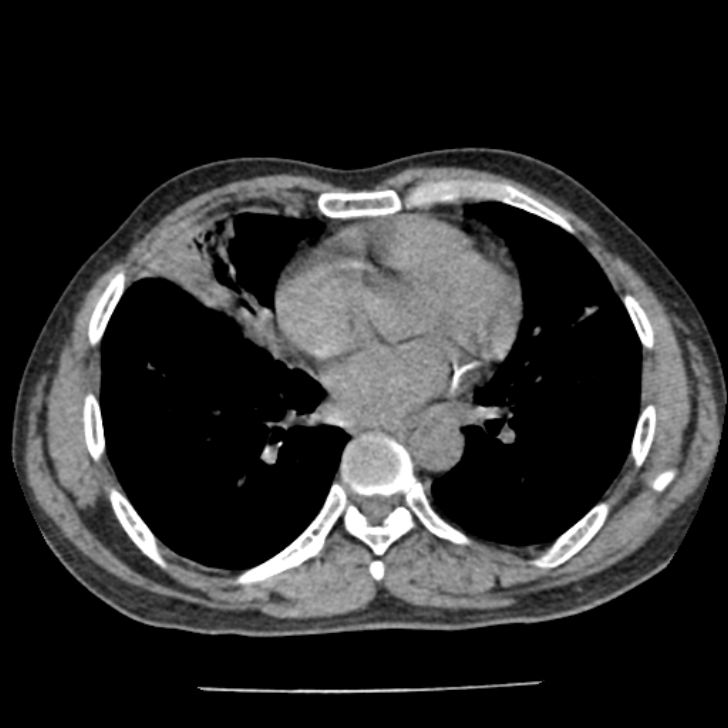 Airway foreign body in adult (Radiopaedia 85907-101779 Axial liver window 113).jpg