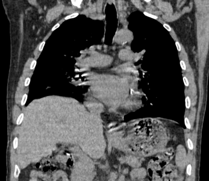 Airway foreign body in adult (Radiopaedia 85907-101779 Coronal liver window 130).jpg
