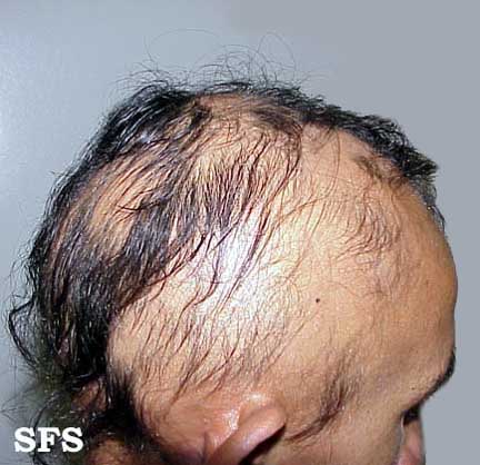 Alopecia Areata (Dermatology Atlas 7).jpg