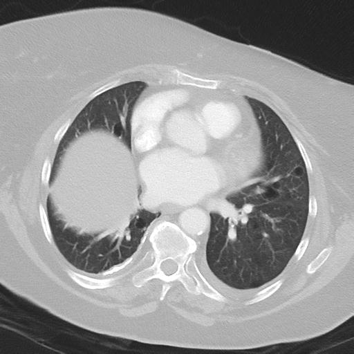 Alveolar hemorrhage and possible lymphocytic interstitial pneumonitis in systemic lupus erythematosus (Radiopaedia 28582-28839 Axial lung window 29).jpg