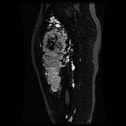 Alveolar soft part sarcoma (Radiopaedia 64501-73678 D 78).jpg