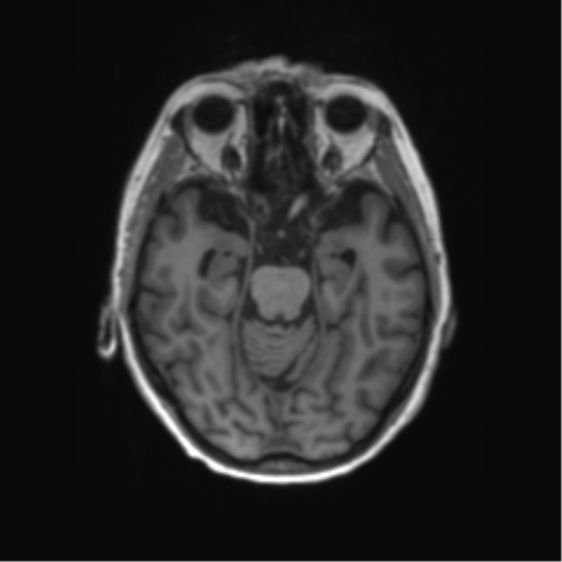 File:Alzheimer's disease (Radiopaedia 42658-45802 Axial T1 99).png