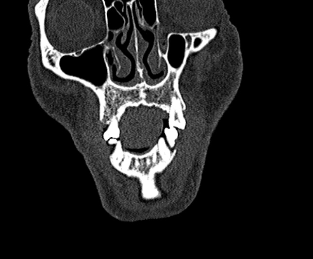 Ameloblastoma (Radiopaedia 51921-57766 Coronal bone window 35).jpg