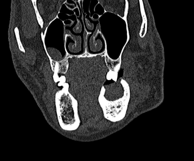 Ameloblastoma (Radiopaedia 51921-57766 Coronal bone window 72).jpg