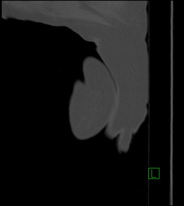 Amiodarone deposition in the liver (Radiopaedia 77587-89780 Sagittal bone window 104).jpg