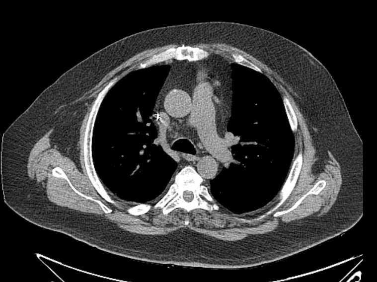 Amiodarone lung (Radiopaedia 62514-70769 Axial non-contrast 34).jpg