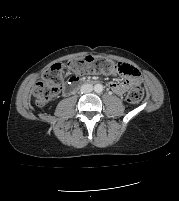 Ampulla of Vater metastasis (Radiopaedia 27820-28069 A 127).jpg