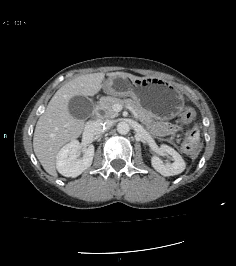 Ampulla of Vater metastasis (Radiopaedia 27820-28069 A 39).jpg