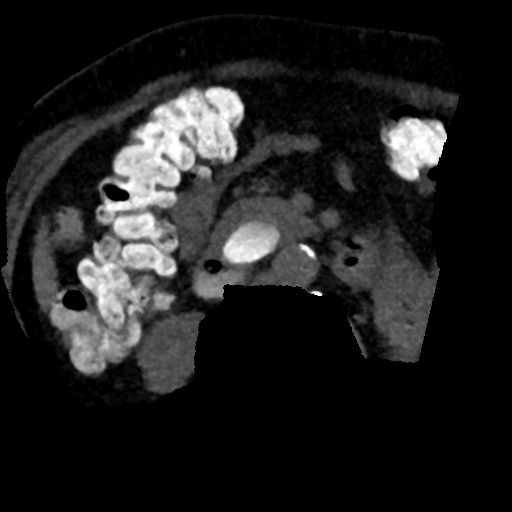 Ampullary adenocarcinoma (Radiopaedia 34013-35241 AXIAL MIPS 3-1.5 81).png