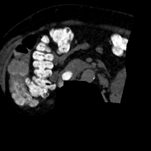 Ampullary adenocarcinoma (Radiopaedia 34013-35241 AXIAL MIPS 3-1.5 89).png