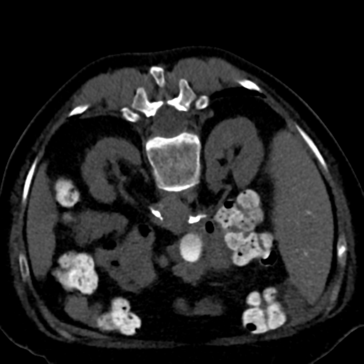 Ampullary adenocarcinoma (Radiopaedia 34013-35241 C 41).png