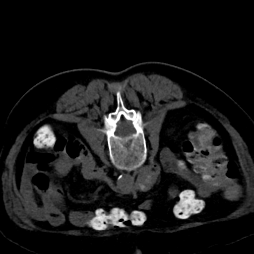 Ampullary adenocarcinoma (Radiopaedia 34013-35241 C 60).png