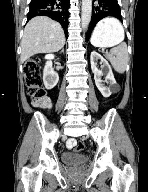 Ampullary adenocarcinoma (Radiopaedia 86093-102032 C 45).jpg