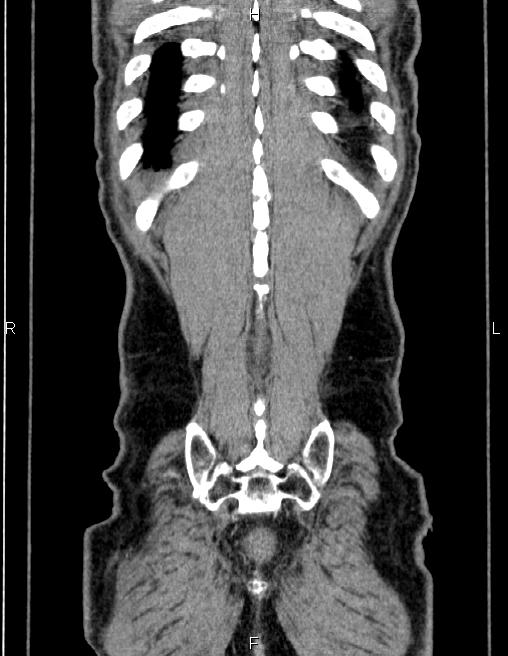 Ampullary adenocarcinoma (Radiopaedia 86093-102032 C 63).jpg