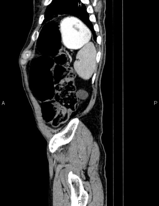Ampullary adenocarcinoma (Radiopaedia 86093-102032 D 86).jpg