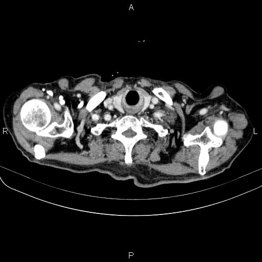 Ampullary adenocarcinoma (Radiopaedia 86093-102033 B 11).jpg
