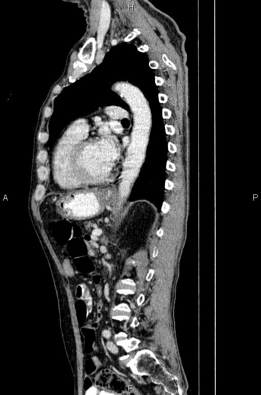 Ampullary adenocarcinoma (Radiopaedia 86093-102033 E 58).jpg