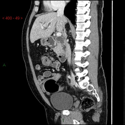 Ampullary carcinoma (Radiopaedia 56396-63056 D 48).jpg