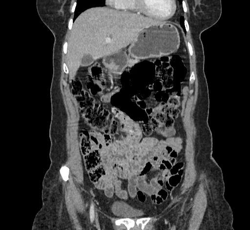 Ampullary tumor (Radiopaedia 60333-67998 B 20).jpg