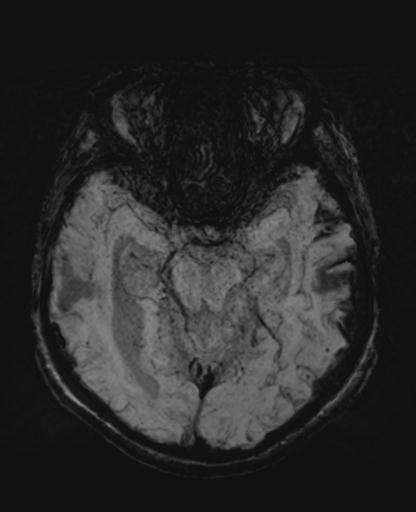 File:Amyloid angiopathy with inflammation (Radiopaedia 30360-31002 Axial SWI MIP 16).jpg