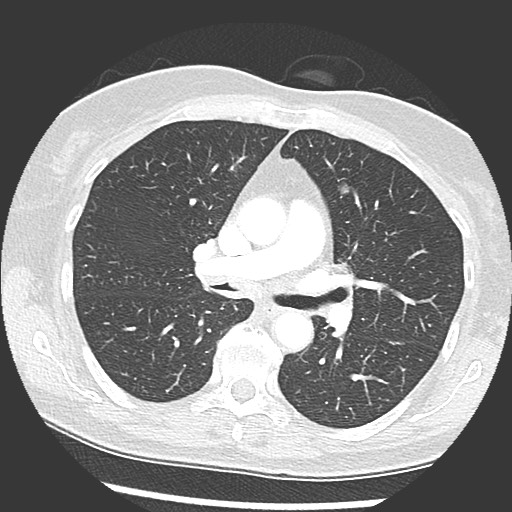 Amyloidosis - bronchial and diffuse nodular pulmonary involvement (Radiopaedia 60156-67745 Axial lung window 35).jpg