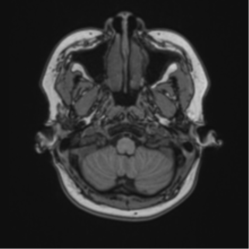 Anaplastic astroblastoma (Radiopaedia 55666-62194 Axial T1 10).png