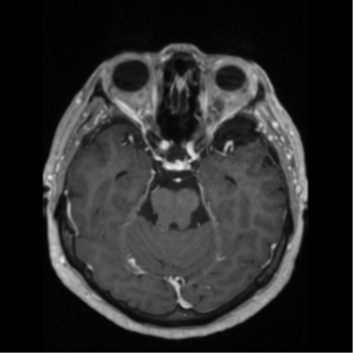 File:Anaplastic astrocytoma IDH wild-type (pseudoprogression) (Radiopaedia 42209-45276 Axial T1 C+ 57).png