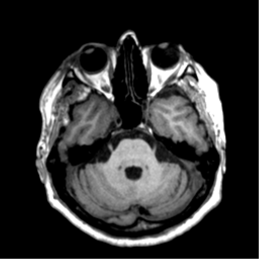 File:Anaplastic astrocytoma IDH wild-type (pseudoprogression) (Radiopaedia 42209-45277 Axial T1 38).png