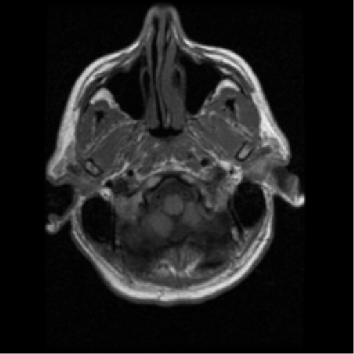 File:Anaplastic meningioma with recurrence (Radiopaedia 34452-35783 Axial T1 1).png