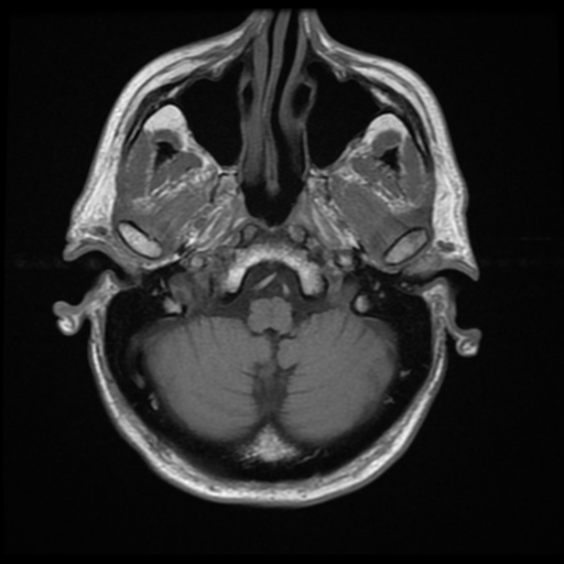 File:Anaplastic meningioma with recurrence (Radiopaedia 34452-35791 Axial T1 3).png