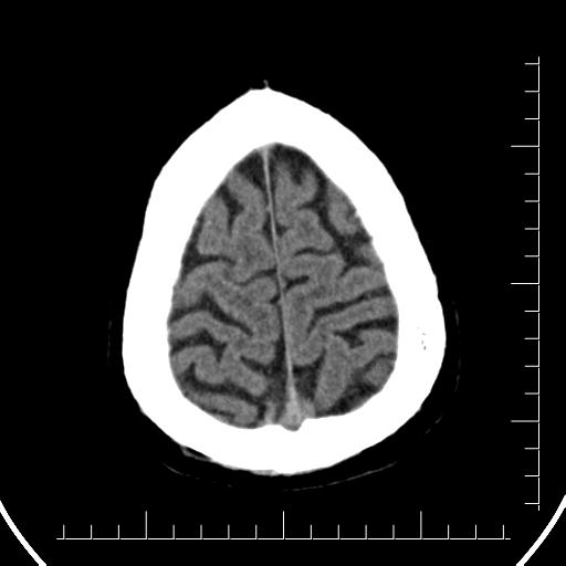 File:Aneurysm of posterior communicating artery (Radiopaedia 20188-20162 Axial non-contrast 43).jpg