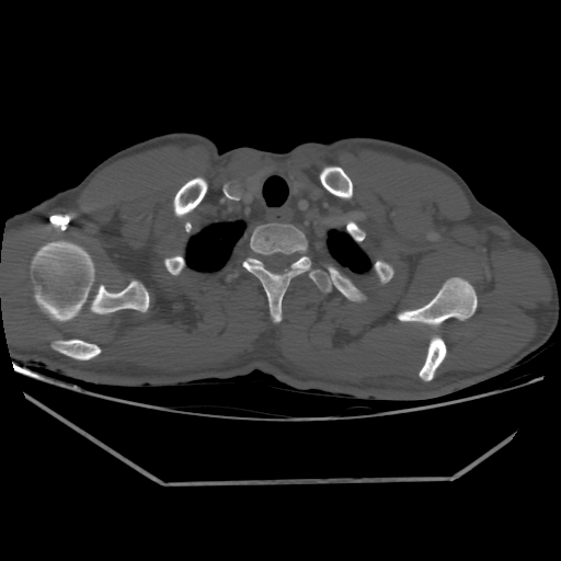 Aneurysmal bone cyst - rib (Radiopaedia 82167-96220 Axial bone window 44).jpg