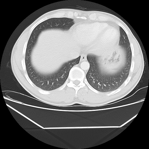 File:Aneurysmal bone cyst - rib (Radiopaedia 82167-96220 Axial lung window 51).jpg