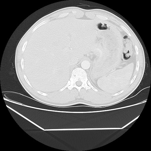 File:Aneurysmal bone cyst - rib (Radiopaedia 82167-96220 Axial lung window 59).jpg