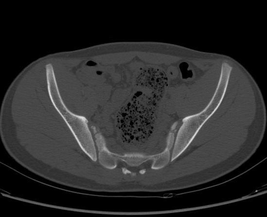 File:Aneurysmal bone cyst of ischium (Radiopaedia 25957-26094 Axial bone window 32).png