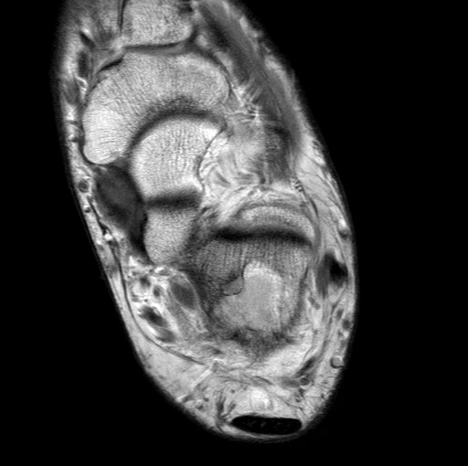 File:Aneurysmal bone cyst of the calcaneus (Radiopaedia 60669-68420 Axial PD 15).jpg
