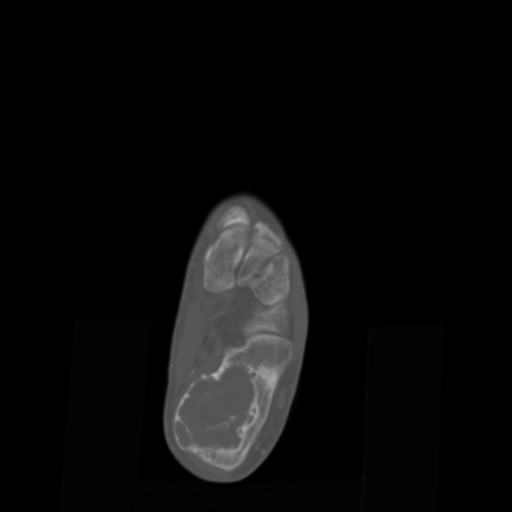 File:Aneurysmal bone cyst of the calcaneus (Radiopaedia 60669-68421 Axial bone window 9).jpg