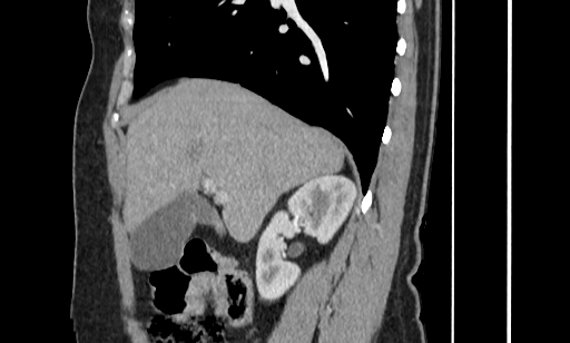Annular pancreas (Radiopaedia 70359-80453 B 22).jpg