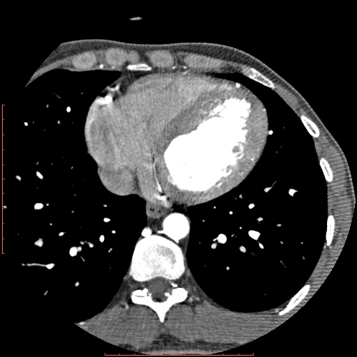 Anomalous left coronary artery from the pulmonary artery (ALCAPA) (Radiopaedia 70148-80181 A 255).jpg