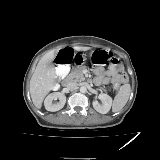 Anorectal carcinoma (Radiopaedia 44413-48064 A 18).jpg
