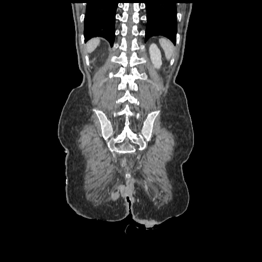 Anorectal carcinoma (Radiopaedia 44413-48064 B 76).jpg