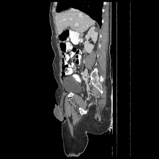 Anorectal carcinoma (Radiopaedia 44413-48064 C 36).jpg