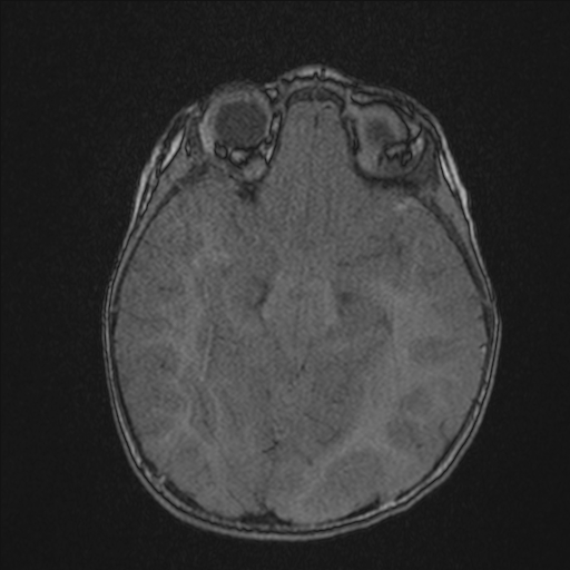 Anoxic brain injury (Radiopaedia 79165-92139 Axial MRA 100).jpg