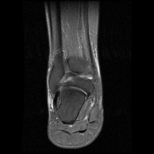 File:Anterior calcaneal process fracture (Radiopaedia 71377-81705 Coronal PD fat sat 11).jpg
